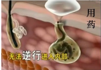 药物无法治好腋臭 a市场上各种狐臭治疗方法对比1.JPG